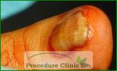 Ingrown Toenail